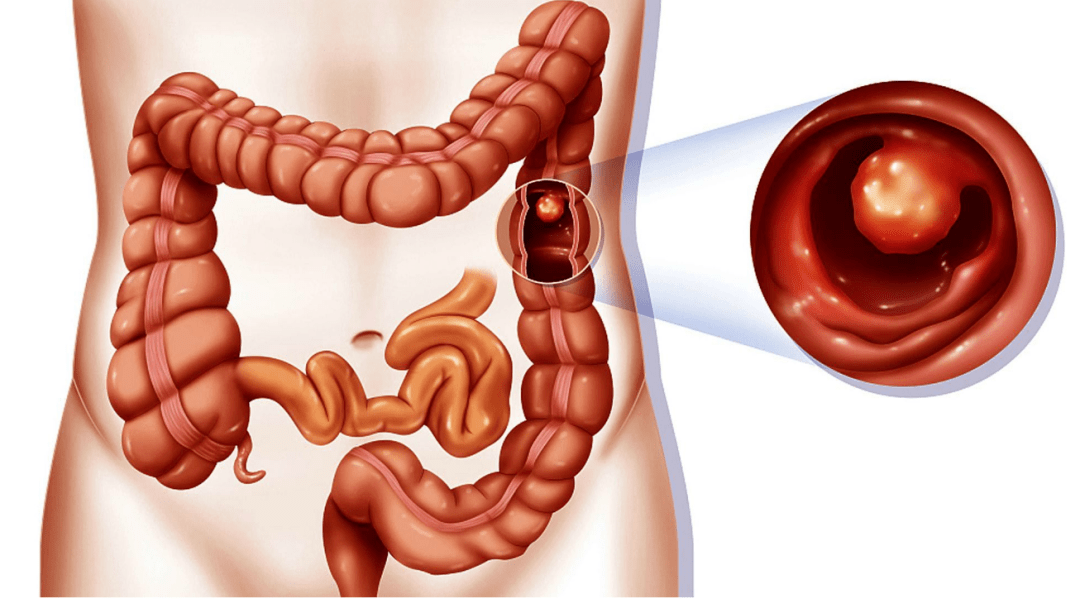 中醫(yī)胃腸肛門病科丨肛腸疾病不用愁，每周日中醫(yī)肛腸主任為您提供一站式治療方案